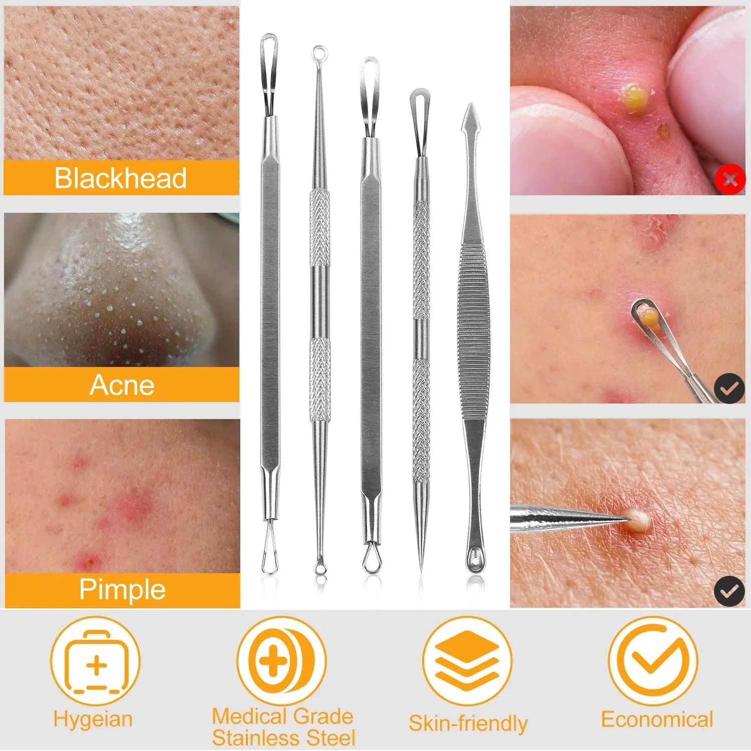 5-Piece Set: Blackhead Remover Kit Stainless Steel Popping Zit Remover